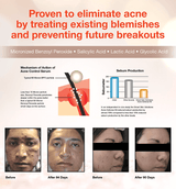 Acne Clear Detox Mask